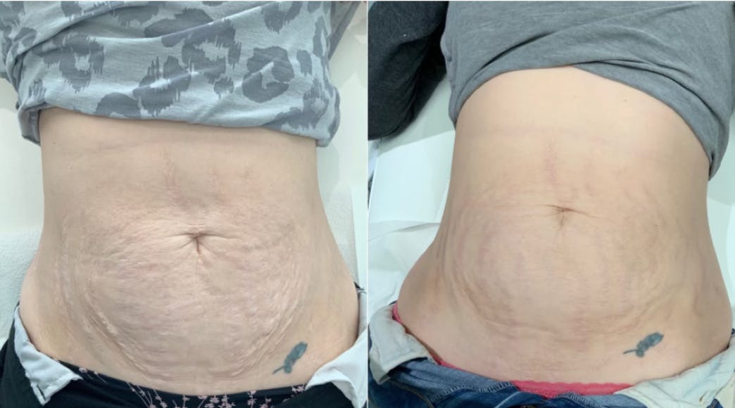 Magic Laser Eraser™ (Body) Before & After Gallery - Patient 65644760 - Image 1