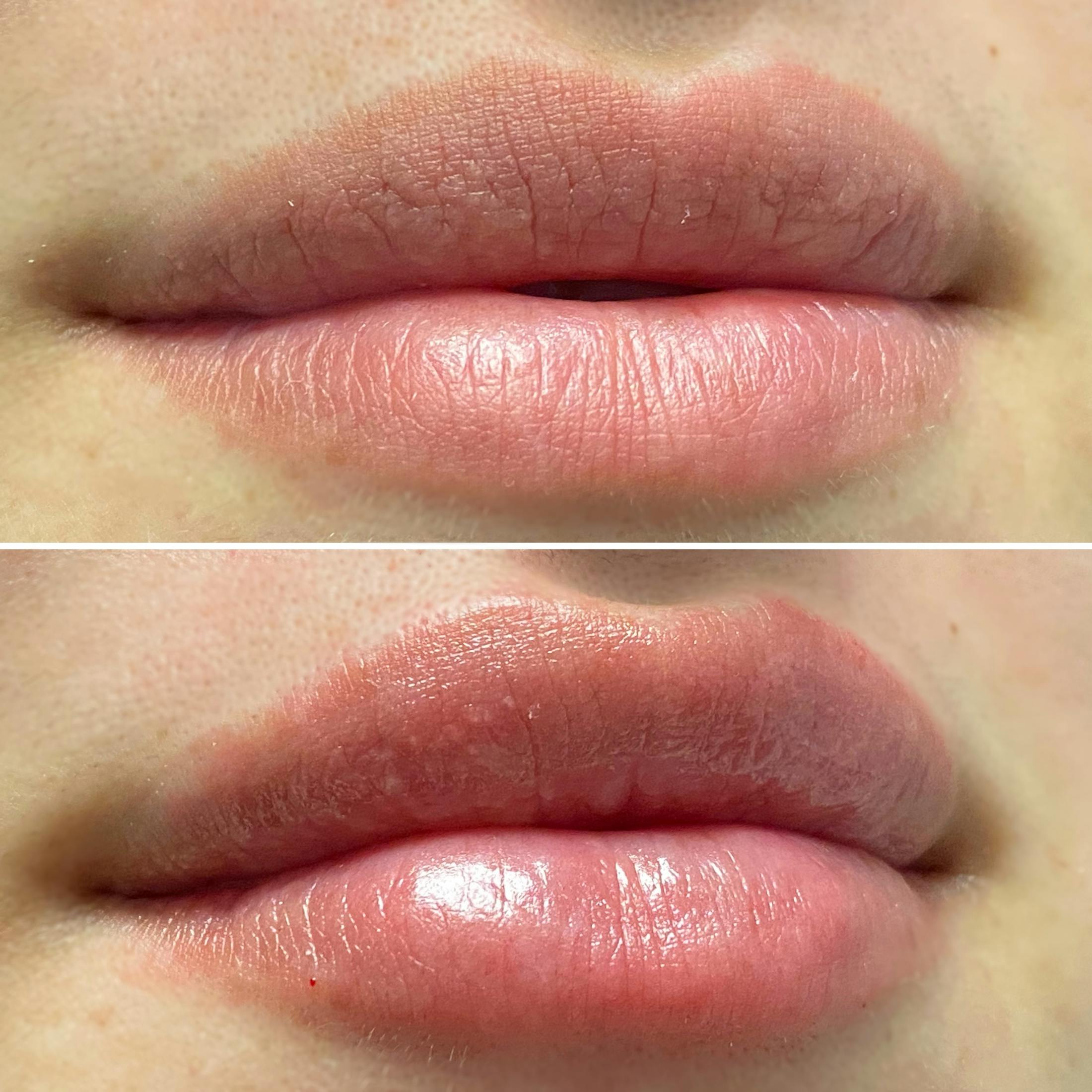Petite Pout® Before & After Gallery - Patient 65646245 - Image 1