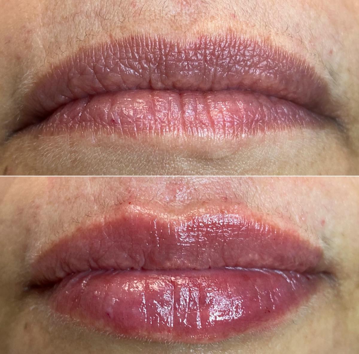 Petite Pout® Before & After Gallery - Patient 65646246 - Image 1