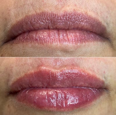 Petite Pout® Before & After Gallery - Patient 65646246 - Image 1