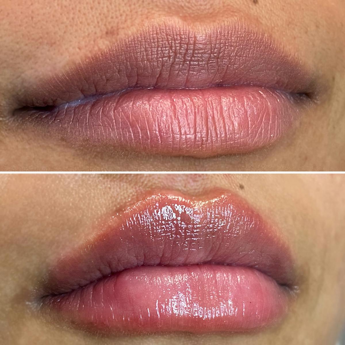 Petite Pout® Before & After Gallery - Patient 65646247 - Image 1