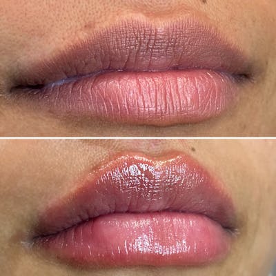 Petite Pout® Before & After Gallery - Patient 65646247 - Image 1