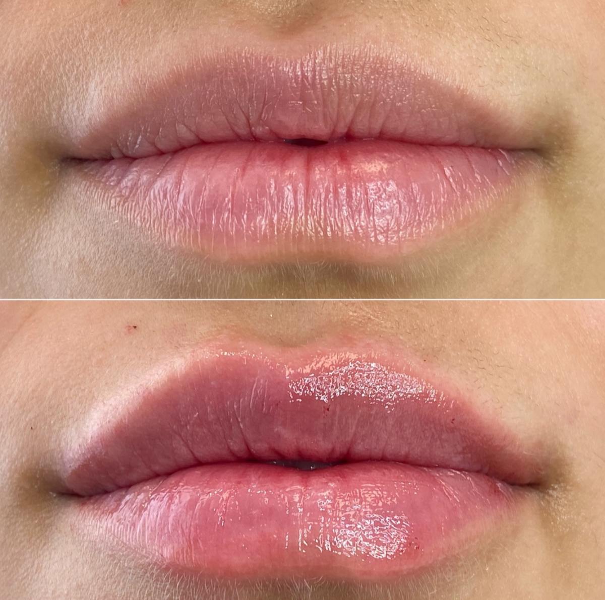 Petite Pout® Before & After Gallery - Patient 65646248 - Image 1