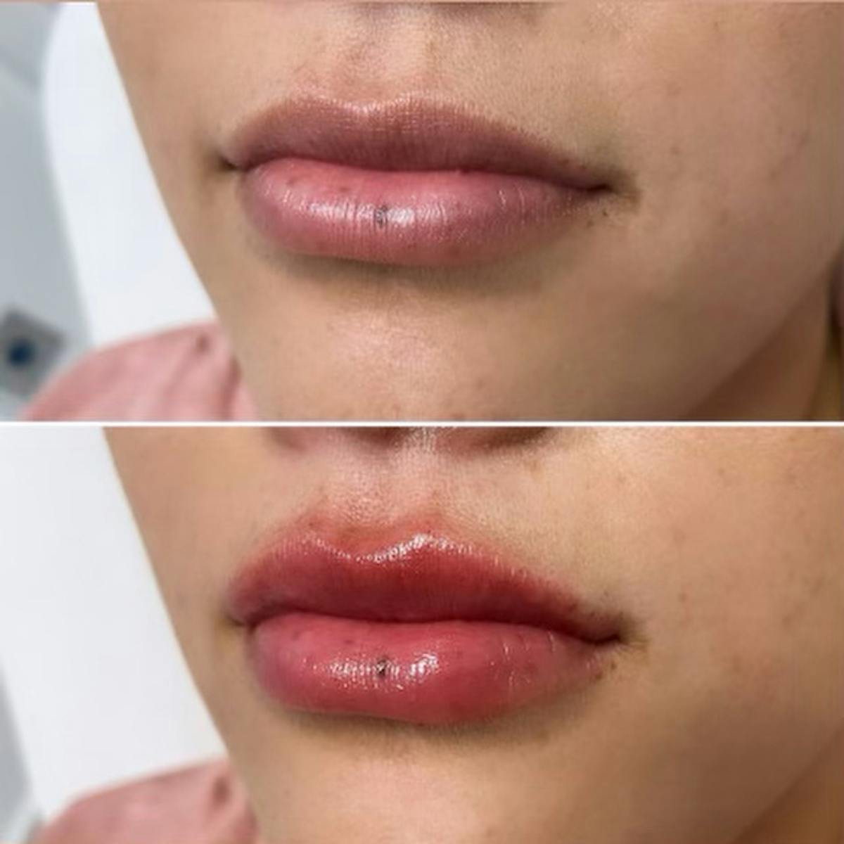 Petite Pout® Before & After Gallery - Patient 65646249 - Image 1