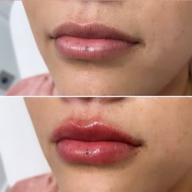 Petite Pout® Before & After Gallery - Patient 65646249 - Image 1