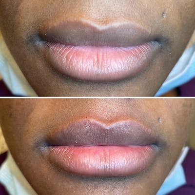 Petite Pout® Before & After Gallery - Patient 65646254 - Image 1