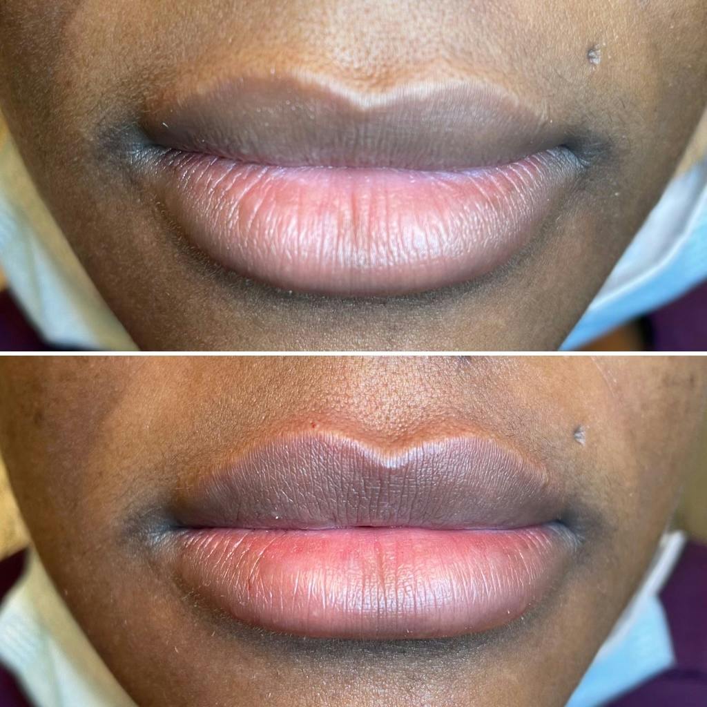 Petite Pout® Before & After Gallery - Patient 65646254 - Image 1