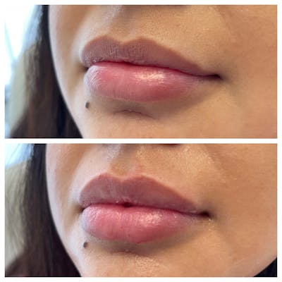 Petite Pout® Before & After Gallery - Patient 65646255 - Image 1