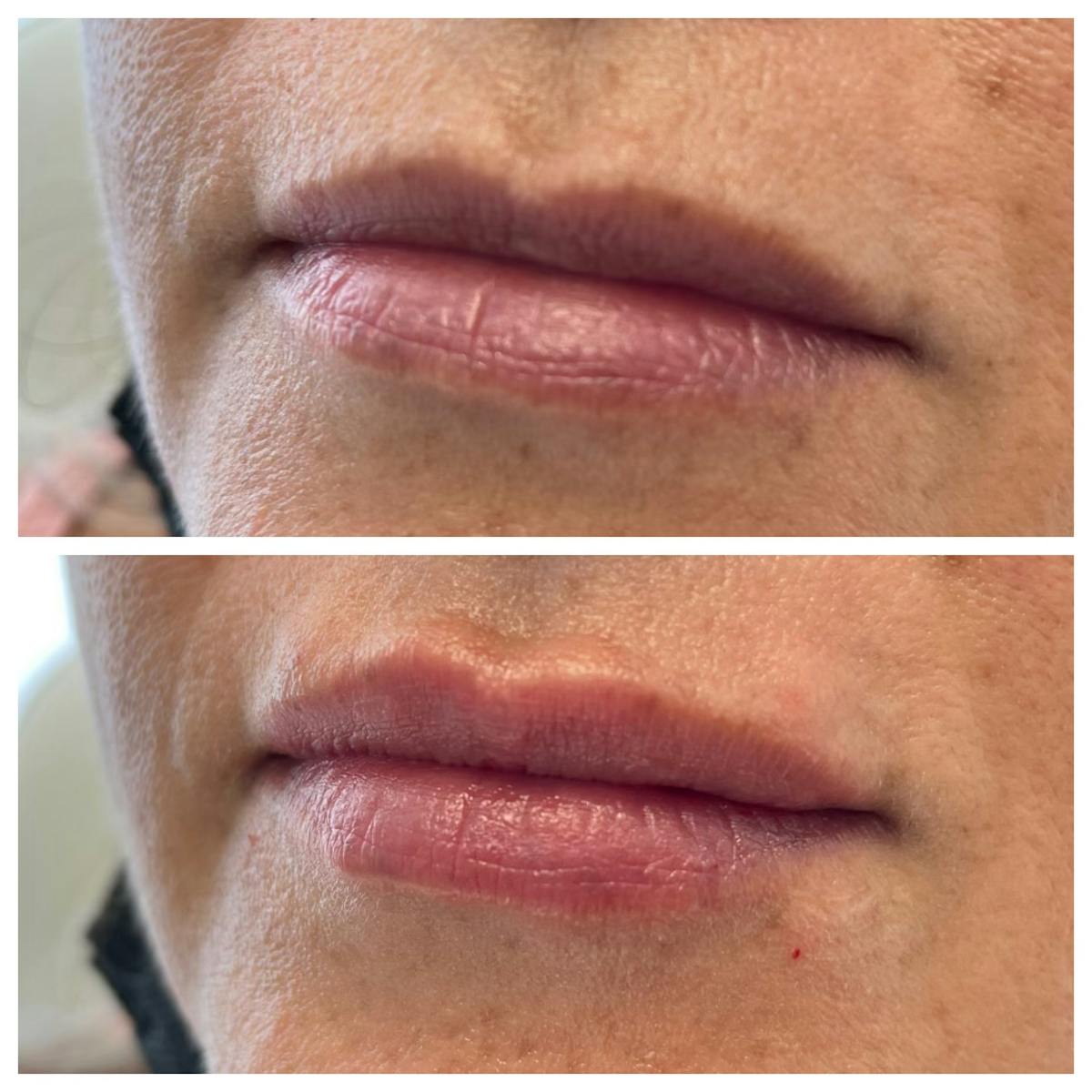 Petite Pout® Before & After Gallery - Patient 65646257 - Image 1