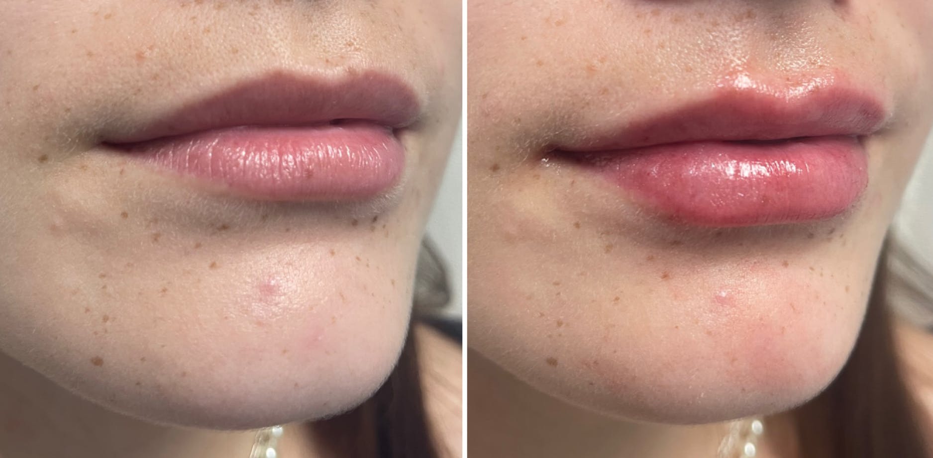 Petite Pout® Before & After Gallery - Patient 65646259 - Image 1