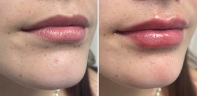 Petite Pout® Before & After Gallery - Patient 65646259 - Image 1
