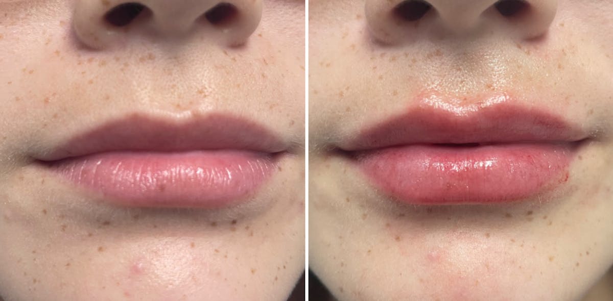 Petite Pout® Before & After Gallery - Patient 65646259 - Image 2