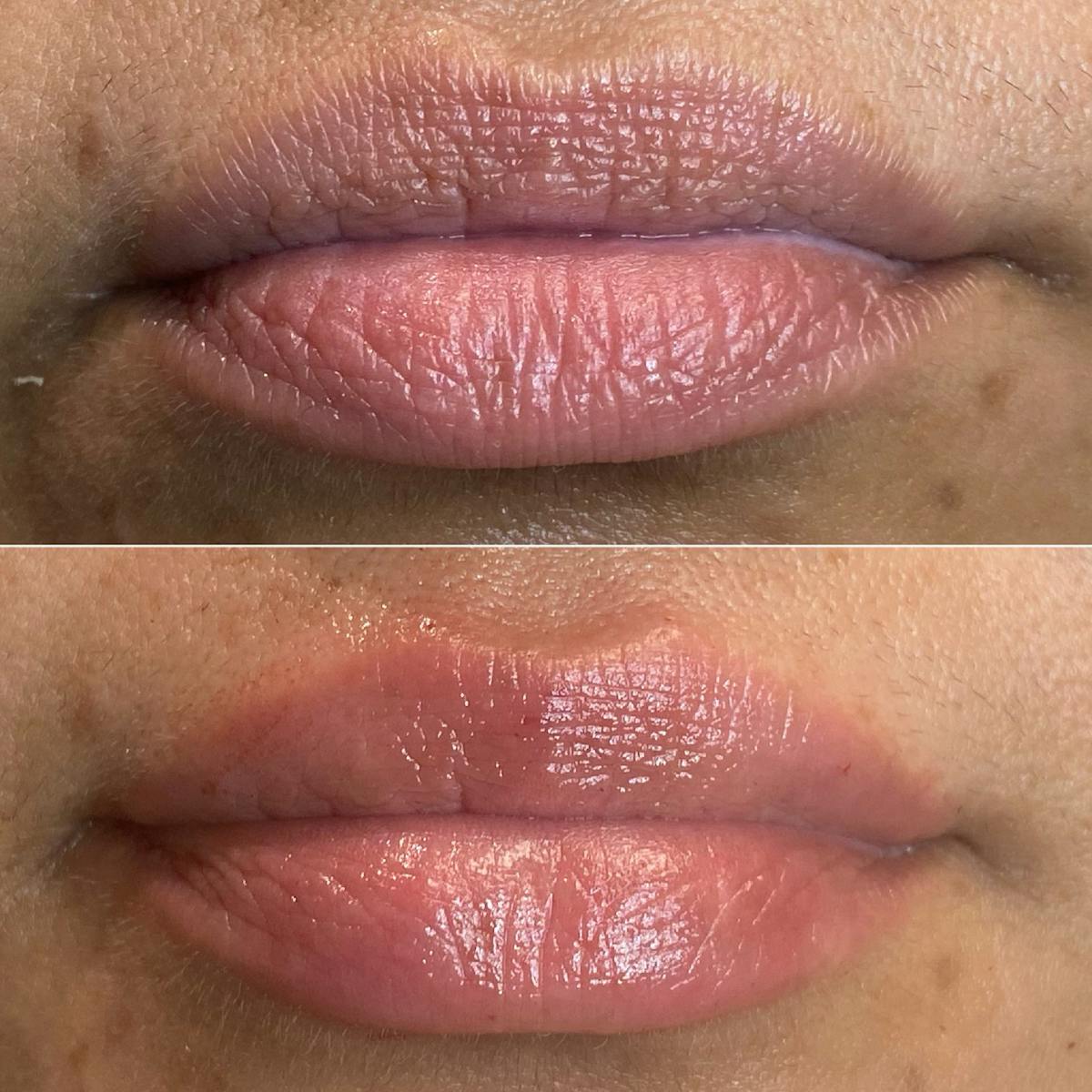 Petite Pout® Before & After Gallery - Patient 65646261 - Image 2