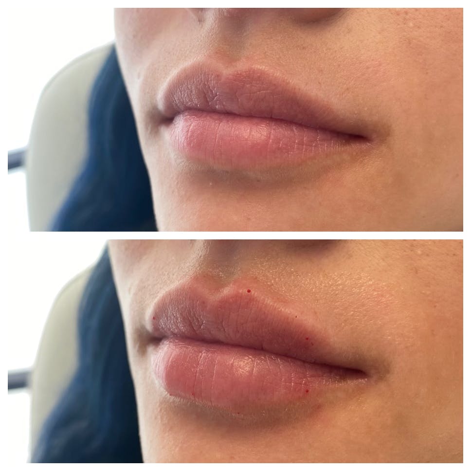 Petite Pout® Before & After Gallery - Patient 65646262 - Image 1