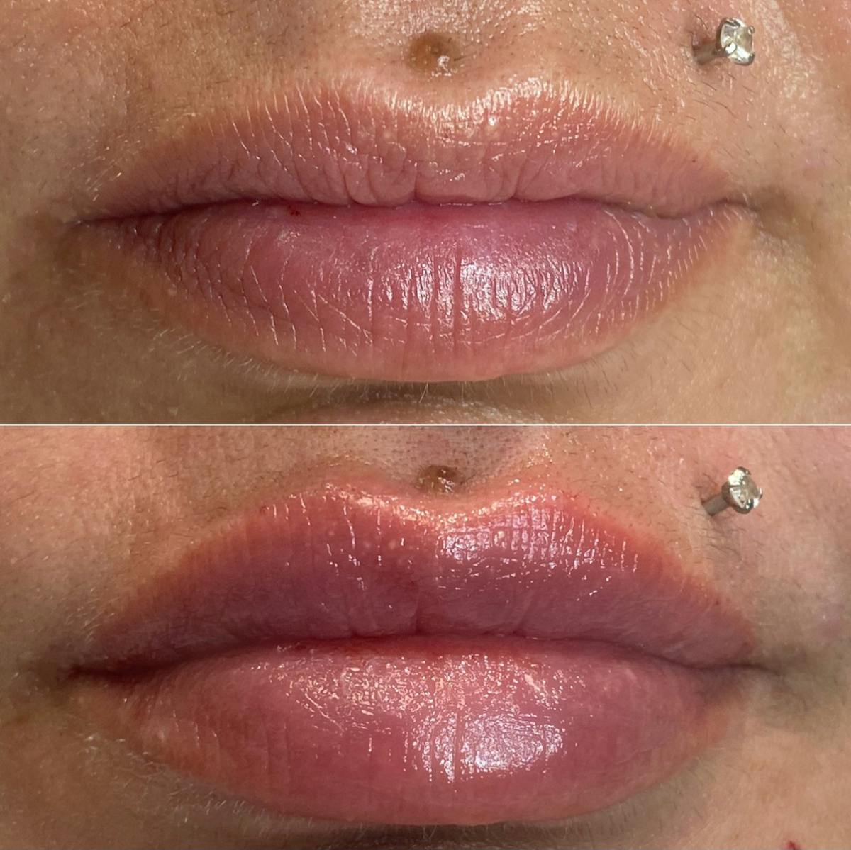 Petite Pout® Before & After Gallery - Patient 65646263 - Image 1
