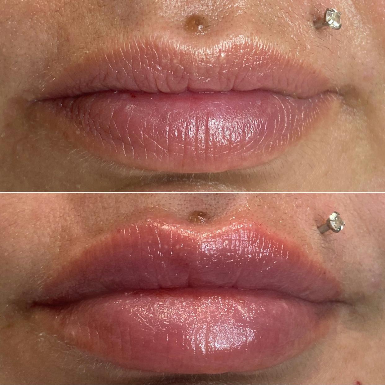 Petite Pout® Before & After Gallery - Patient 65646263 - Image 1