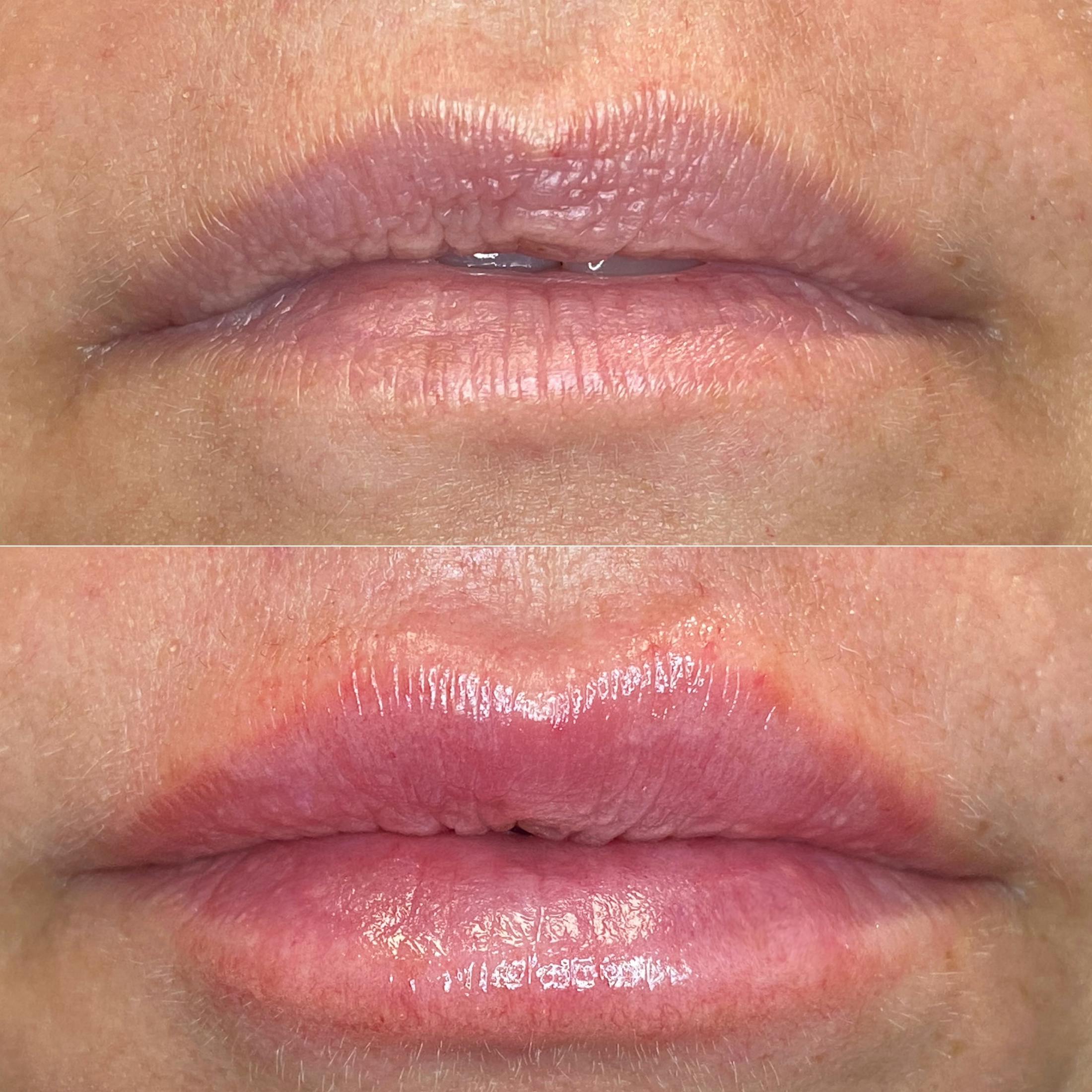 Petite Pout® Before & After Gallery - Patient 65646264 - Image 1