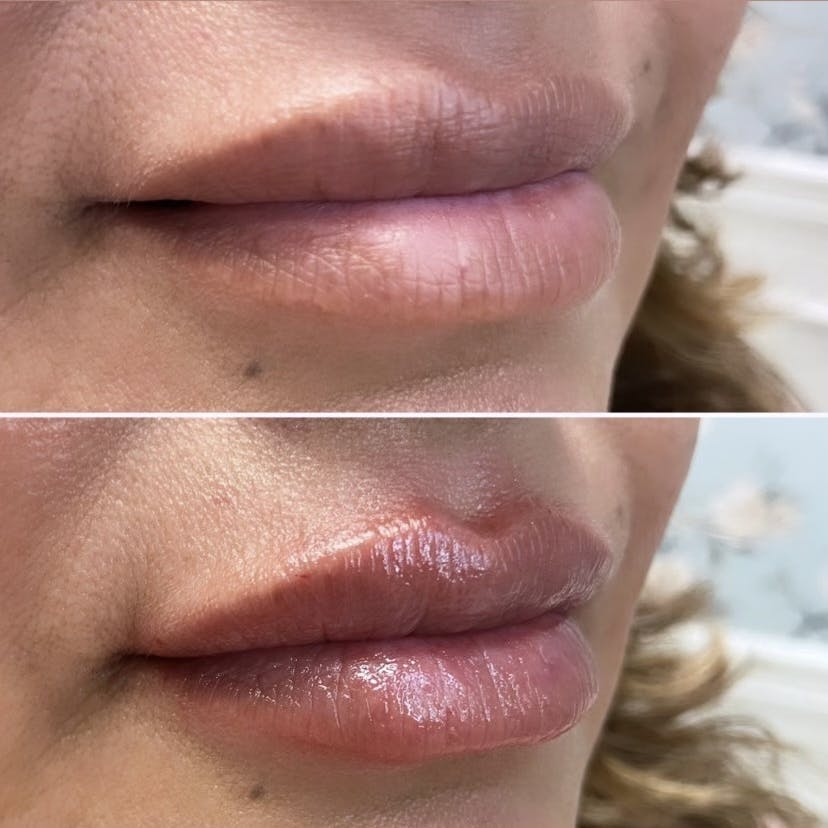 Petite Pout® Before & After Gallery - Patient 65646265 - Image 1