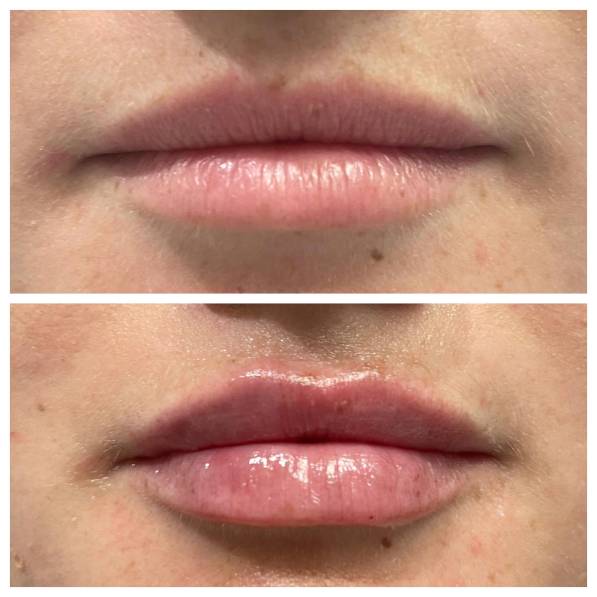 Petite Pout® Before & After Gallery - Patient 65646266 - Image 1