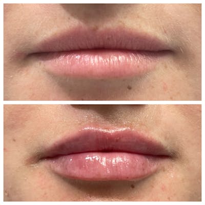 Petite Pout® Before & After Gallery - Patient 65646266 - Image 1