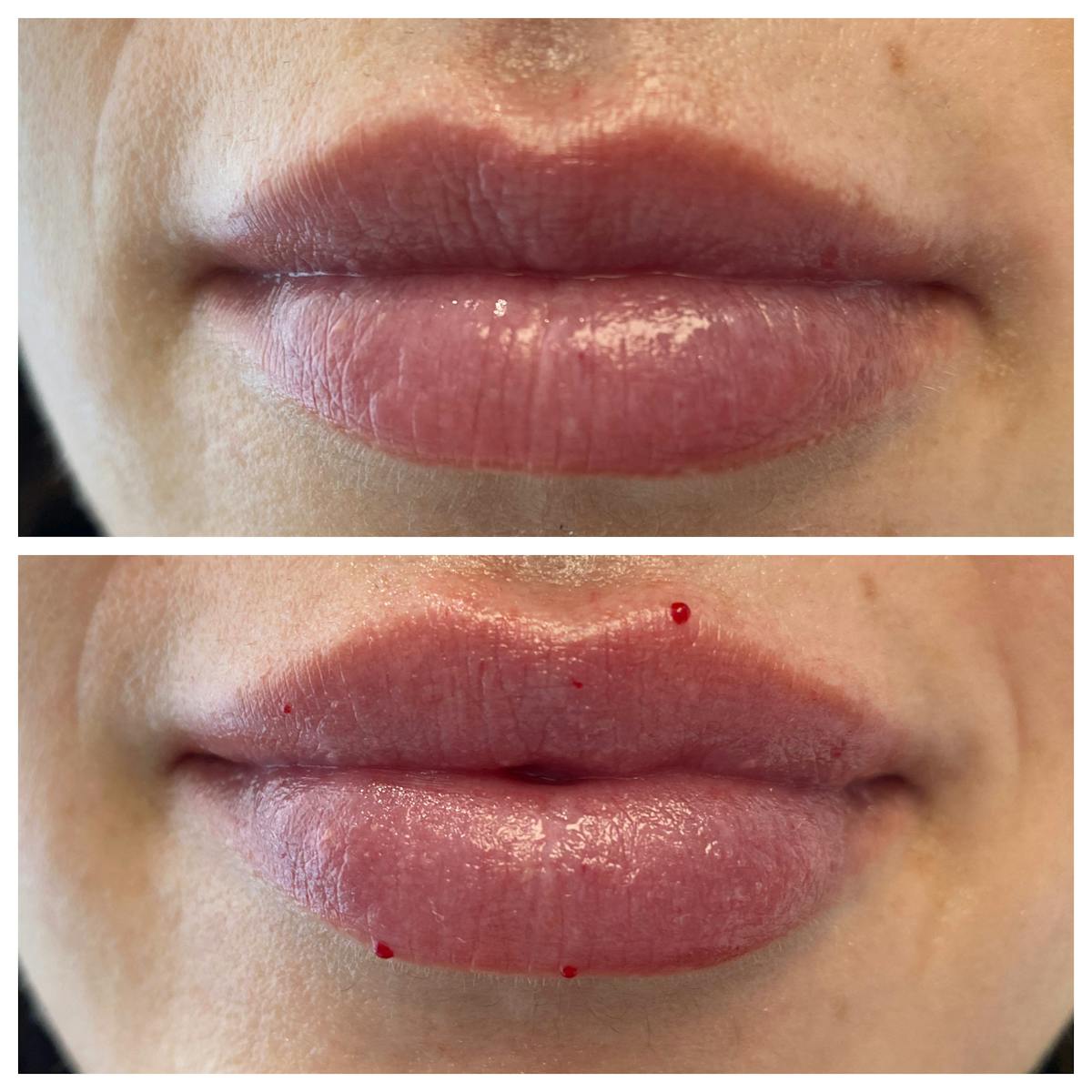 Petite Pout® Before & After Gallery - Patient 65646268 - Image 1