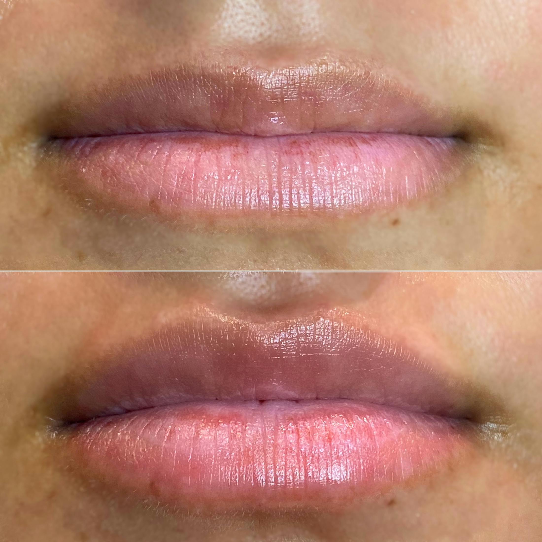 Petite Pout® Before & After Gallery - Patient 65646269 - Image 1