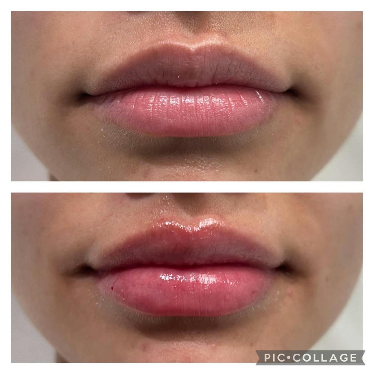 Petite Pout® Before & After Gallery - Patient 65646270 - Image 1