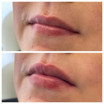Petite Pout® Before & After Gallery - Patient 65646271 - Image 1