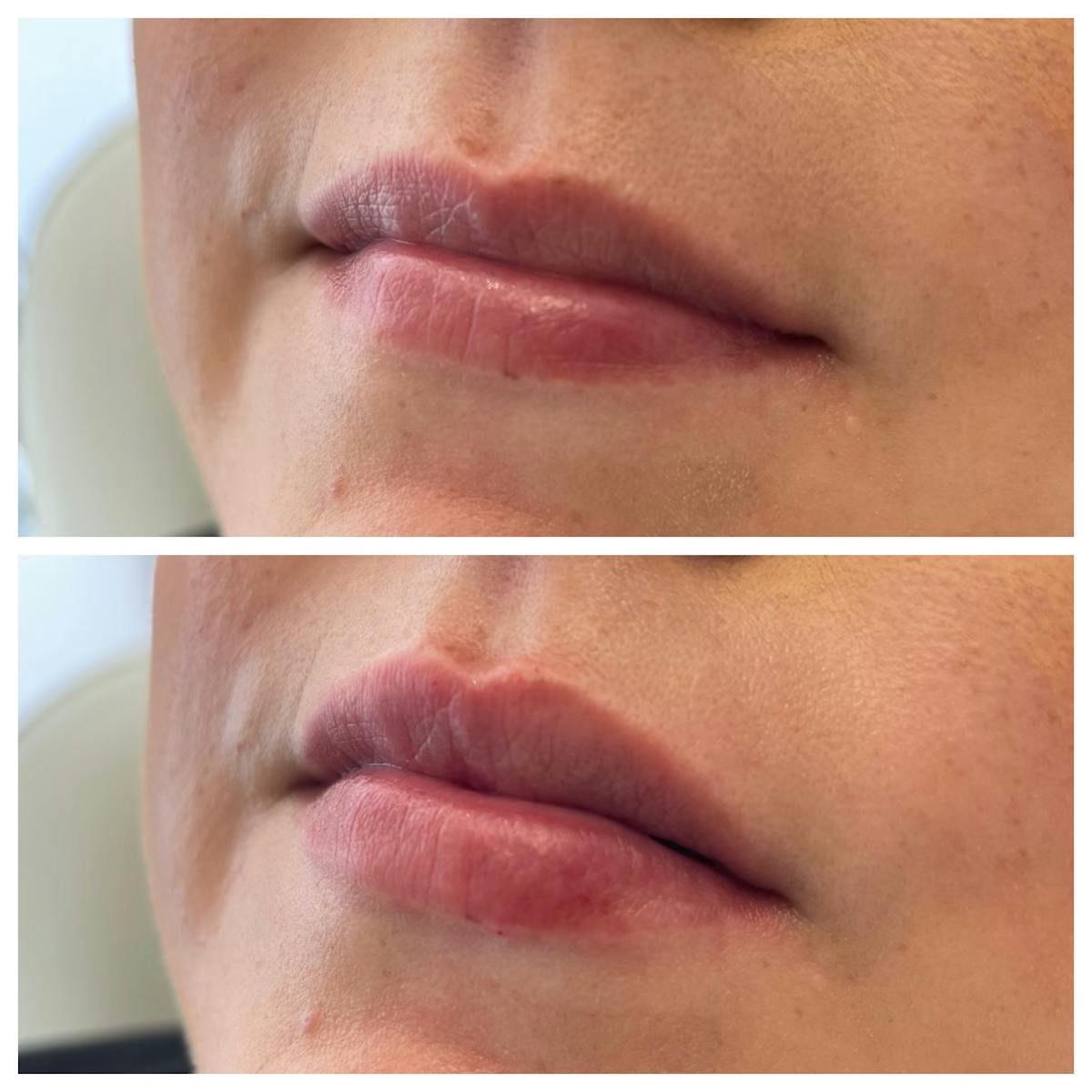 Petite Pout® Before & After Gallery - Patient 65646271 - Image 1