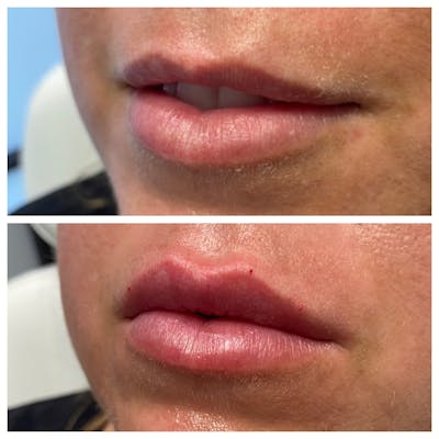 Petite Pout® Before & After Gallery - Patient 65646272 - Image 1