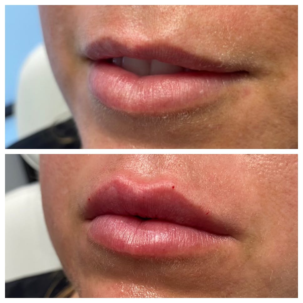 Petite Pout® Before & After Gallery - Patient 65646272 - Image 1