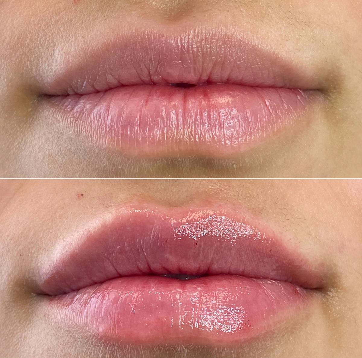 Petite Pout® Before & After Gallery - Patient 65646273 - Image 1