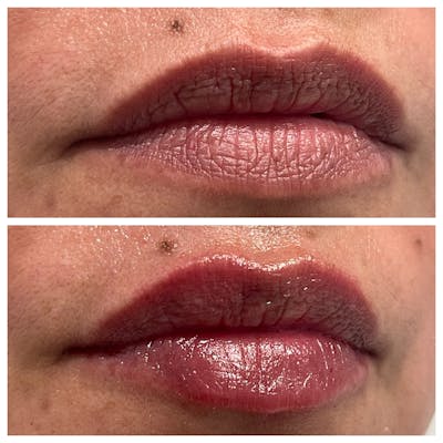 Petite Pout® Before & After Gallery - Patient 65646274 - Image 1