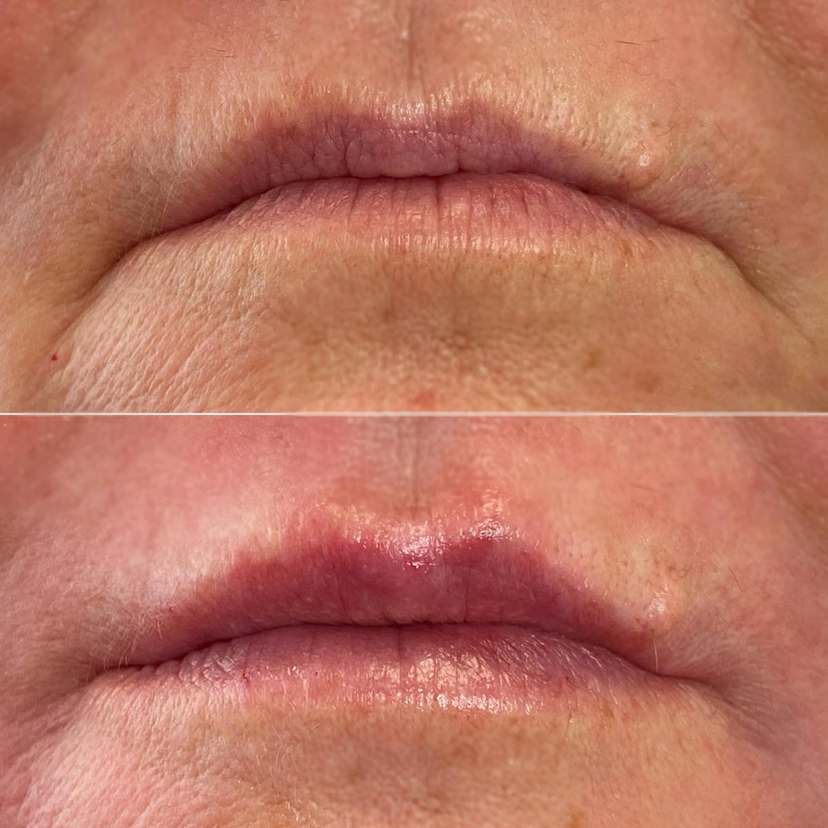 Petite Pout® Before & After Gallery - Patient 65646276 - Image 1