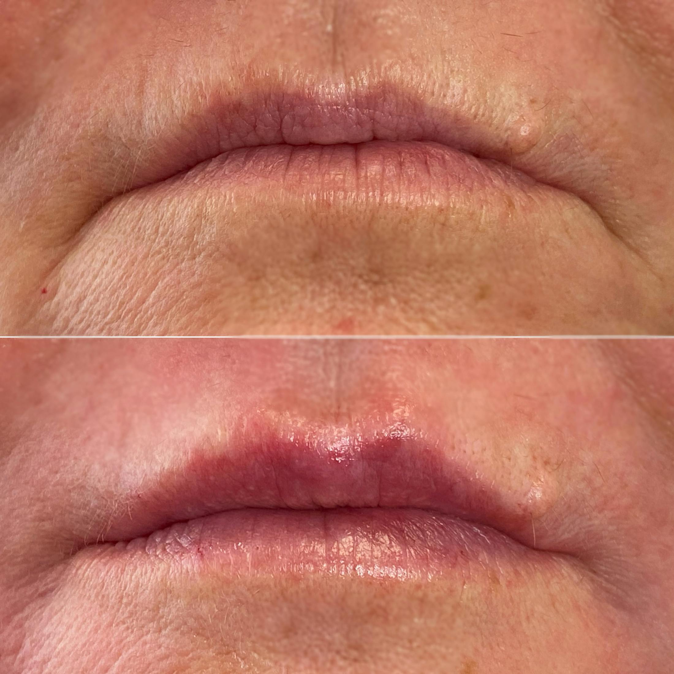 Petite Pout® Before & After Gallery - Patient 65646276 - Image 1