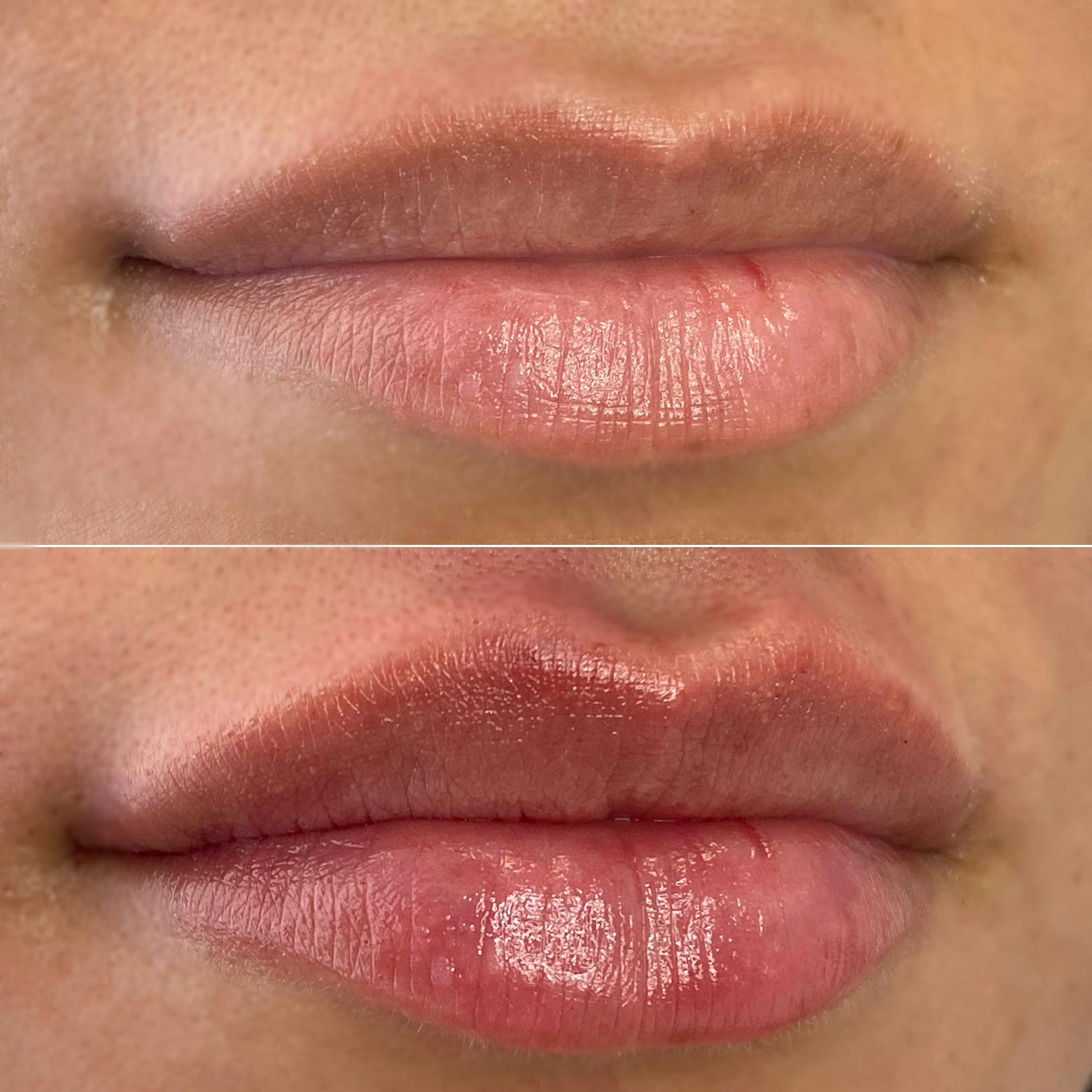 Petite Pout® Before & After Gallery - Patient 65646278 - Image 1