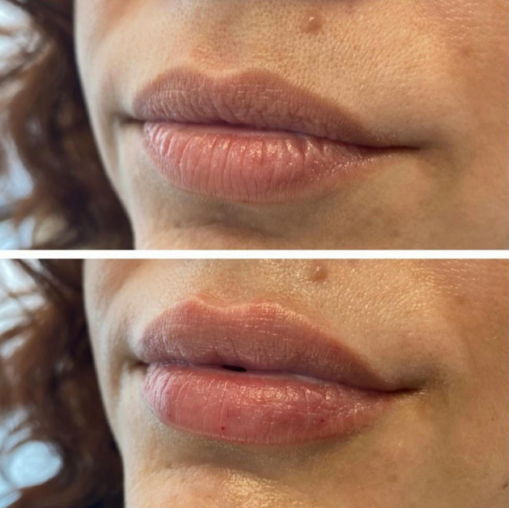 Petite Pout® Before & After Gallery - Patient 65646279 - Image 1