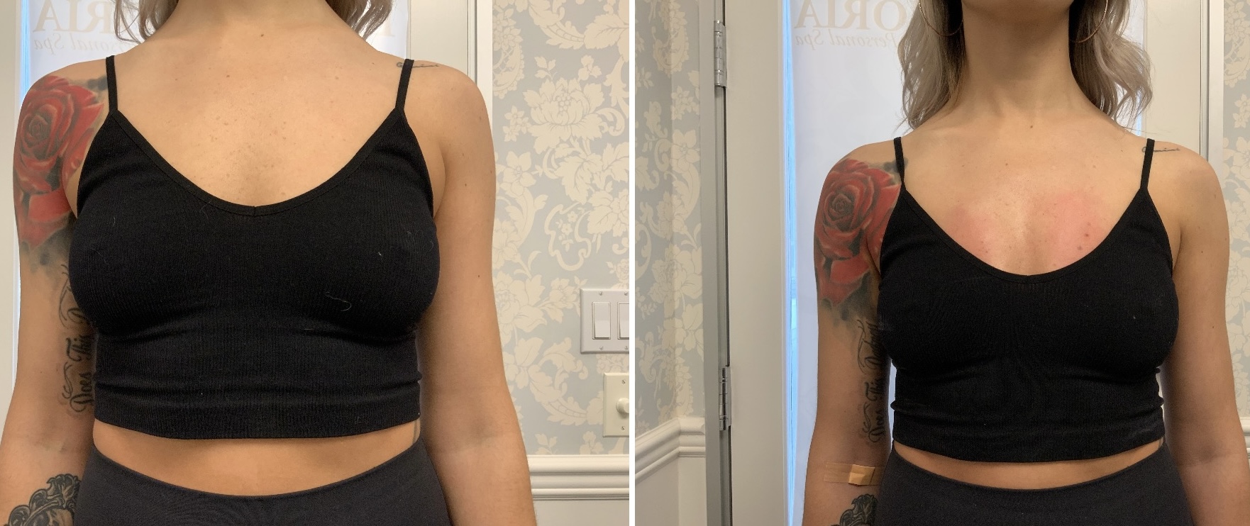 Patient 142703906 Vampire Breast Lift® Before & After Photos EuroPhoria