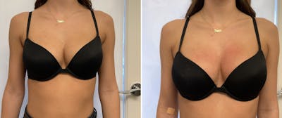 Vampire Breast Lift® Before & After Gallery - Patient 65646388 - Image 1