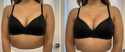 Vampire Breast Lift® Before & After Photos