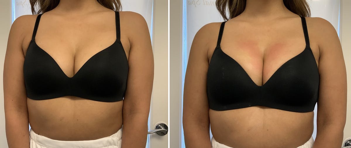 Vampire Breast Lift® Before & After Gallery - Patient 65646389 - Image 1