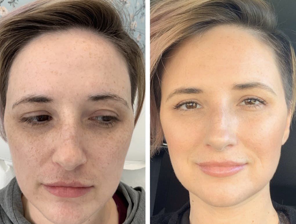 Vampire Facial EUROPHORIA Medical and Personal Spa in Bakersfield & Kern, CA