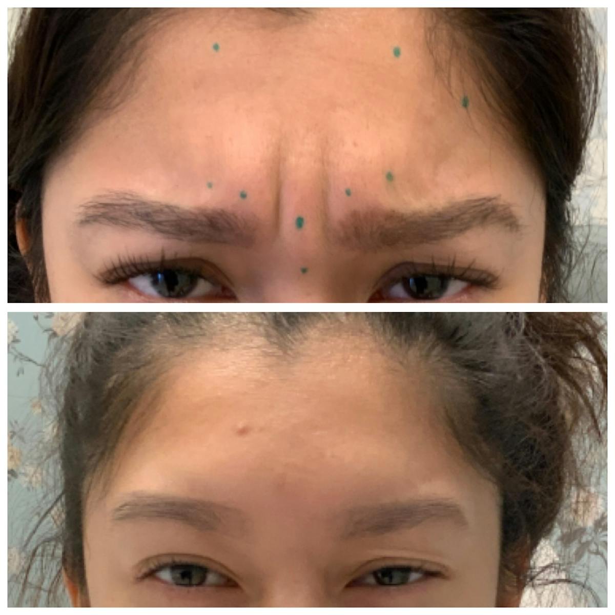Wrinkle Relaxers Before & After Gallery - Patient 65646580 - Image 1