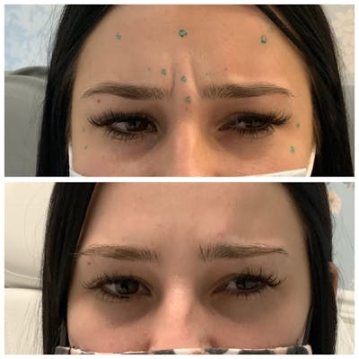 Wrinkle Relaxers Before & After Gallery - Patient 65646581 - Image 1