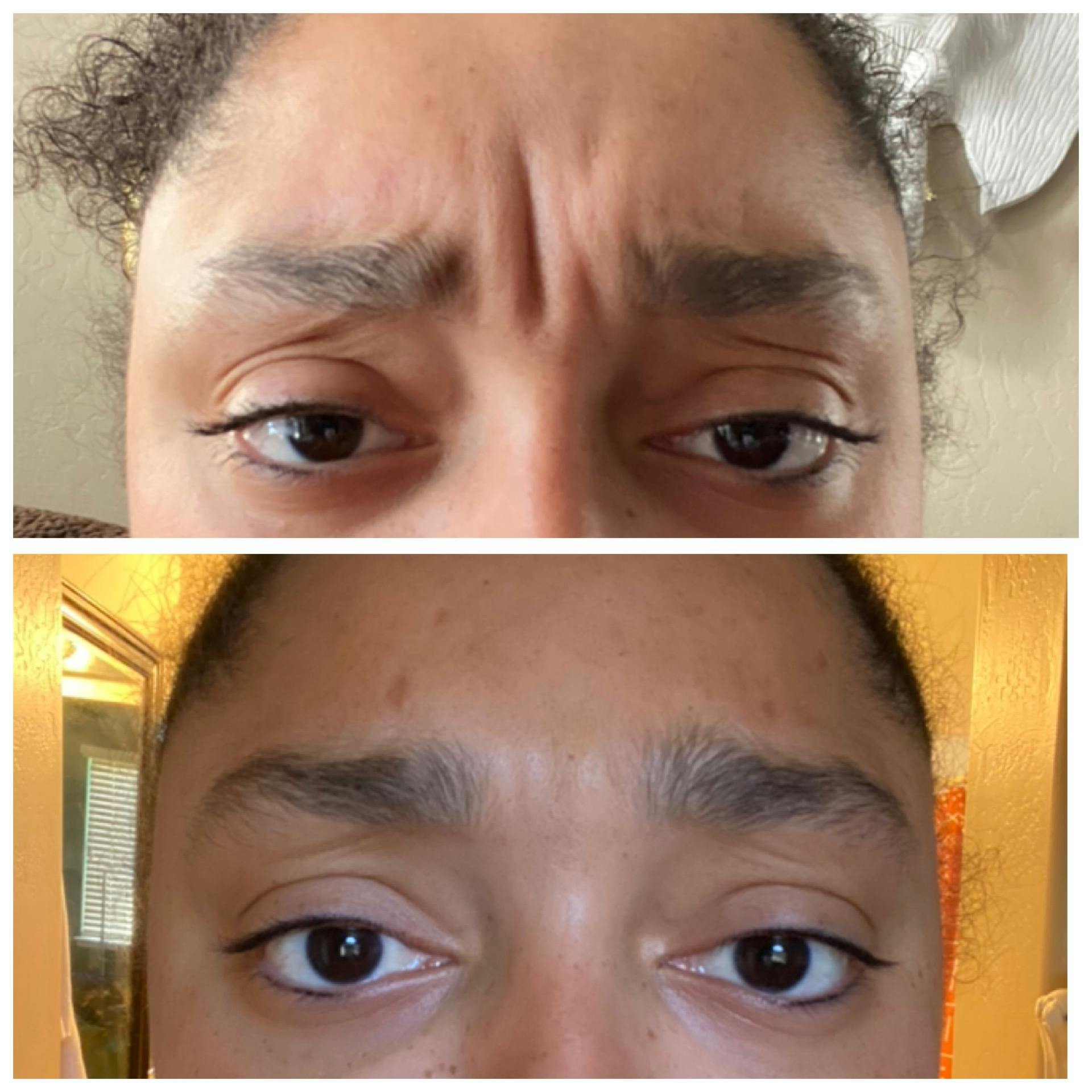 Wrinkle Relaxers Gallery - Patient 65646582 - Image 1