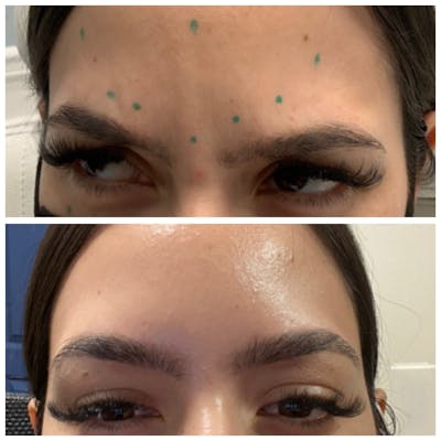 Wrinkle Relaxers Before & After Gallery - Patient 65646583 - Image 1