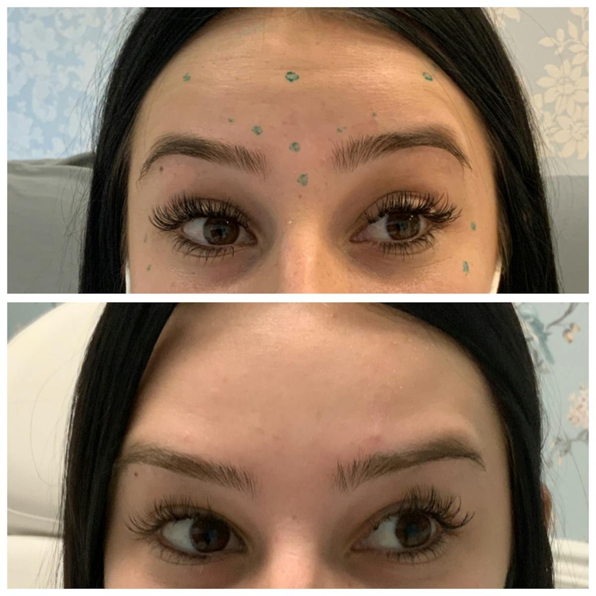Wrinkle Relaxers Before & After Gallery - Patient 65646584 - Image 1