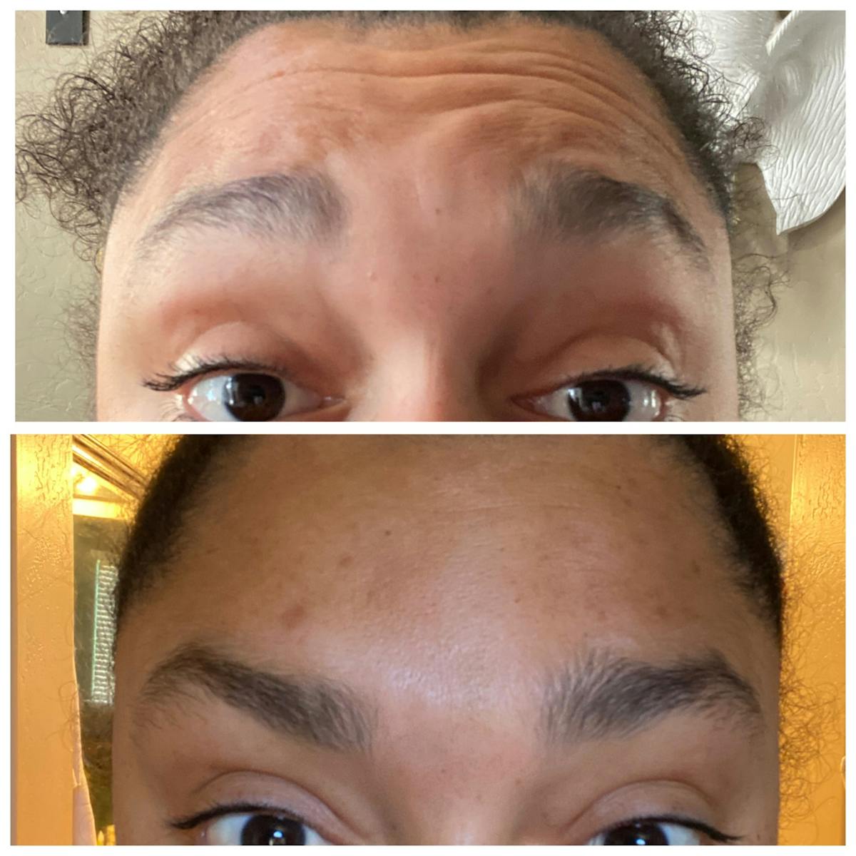 Wrinkle Relaxers Before & After Gallery - Patient 65646585 - Image 1