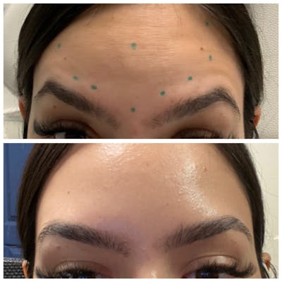 Wrinkle Relaxers Before & After Gallery - Patient 65646586 - Image 1