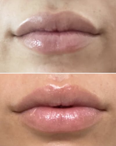 Lip Flip  Before & After Gallery - Patient 148023333 - Image 1
